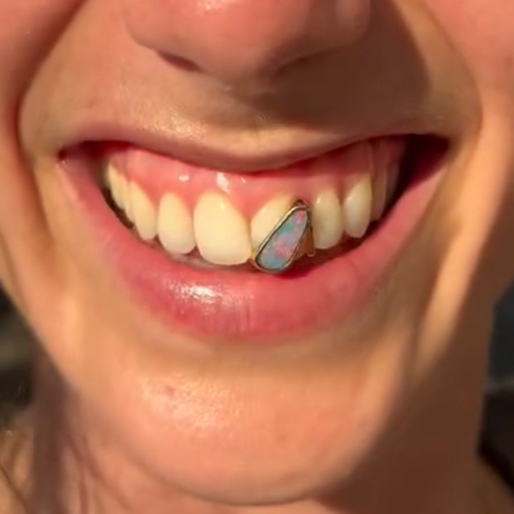 Gold and Australian Opal Tooth Cap